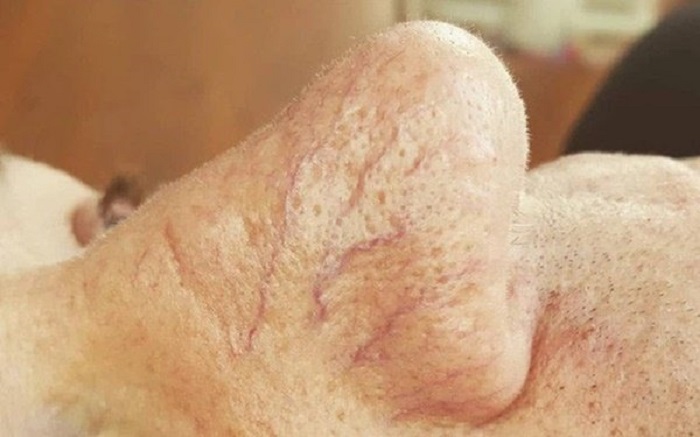 4 biểu hiện bất thường trên da là dấu hiệu sớm của bệnh ung thư gan